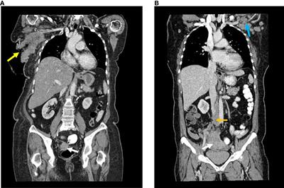 Case report: Axillary lymph node metastases from primary ovarian cancer: a report of two cases and literature review